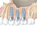 Lo que necesitas saber sobre
IMPLANTES